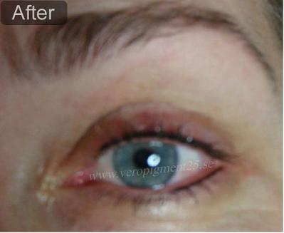 Permanent Makep of Eye Liner - After